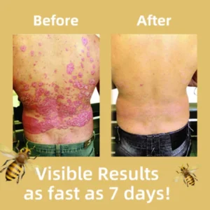 Awzlove™ Bee Venom Psoriasis Treatment Mousse