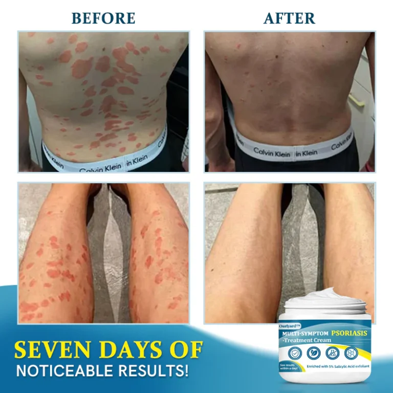 Ourlyard™ Multi-Symptom Psoriasis Treatment Cream - Image 6