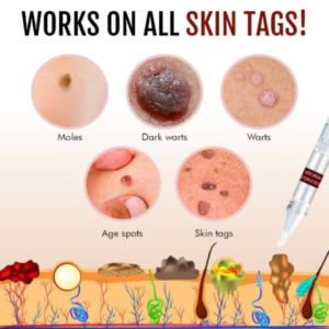 AEXZR™ Tags & Moles Remover