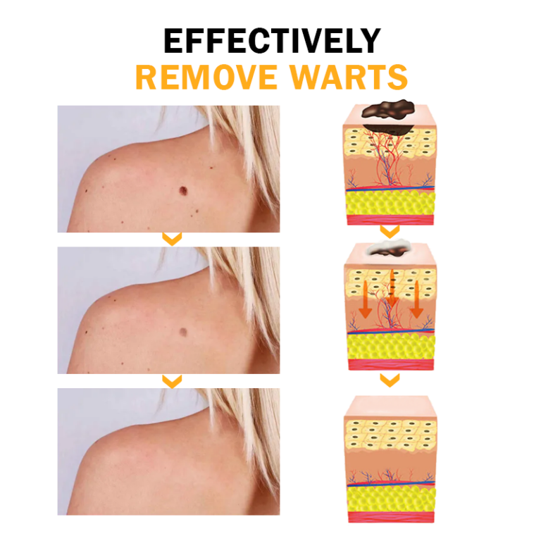 Biancat™ FlawlessFix Mole & Wart Removal Cream