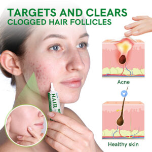 Furzero™ Follicle Acne Purify Cream