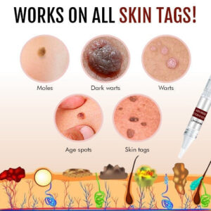 Histone™ Tags & Moles Remover