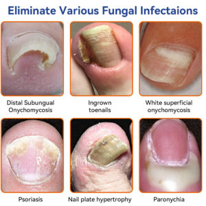 Lotmay® Bee Venom Nail Fungus Treatment Solution