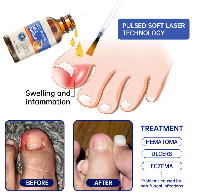 Lotmay® Bee Venom Nail Fungus Treatment Solution