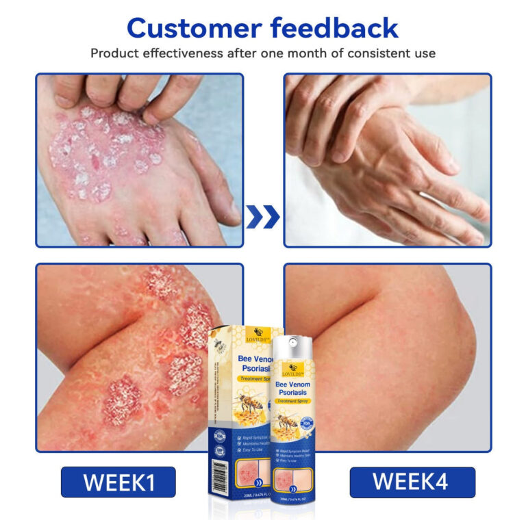 LOVILDS™ PsoriaHeal Bee Venom Psoriasis Treatment Spray