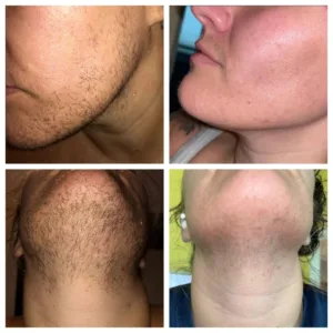 PCOS Facial Hair Solution Serum