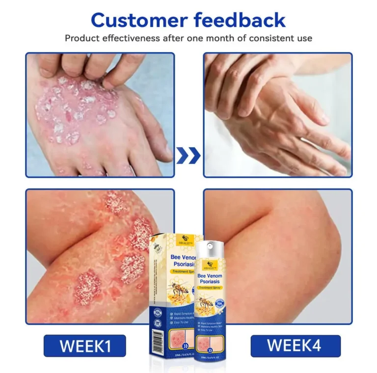 ODALIT™PsoriaHeal psoriasis Spray