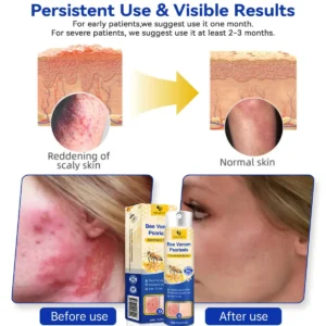 ODALIT™PsoriaHeal psoriasis Spray