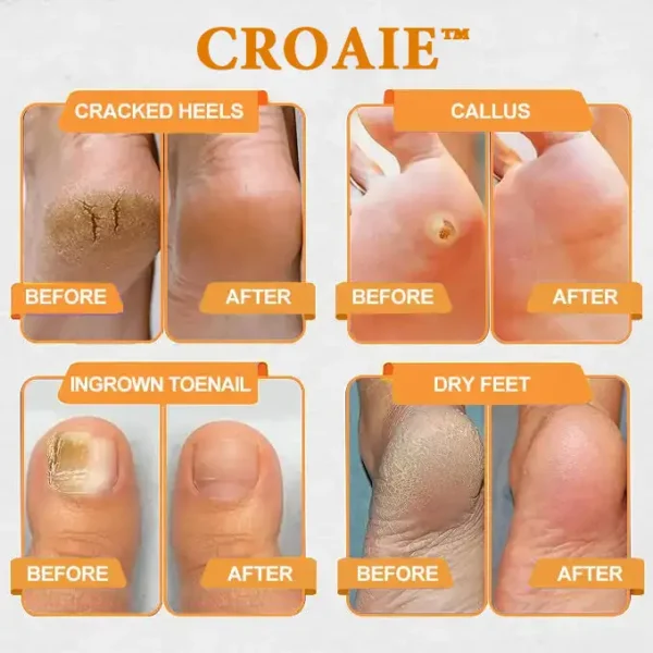 CROAIE™ Bee Venom & Herbal Slimming Foot Patches